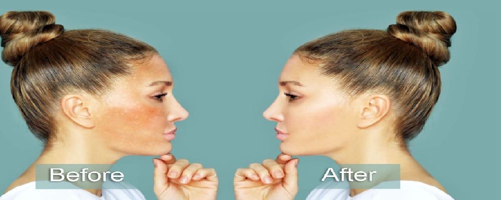 Spoiled Laser Cover Image